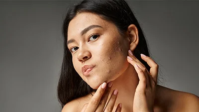 Acne & Acne Scar Treatment